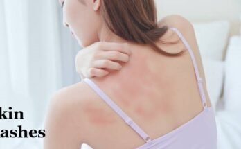 skin rash treatment